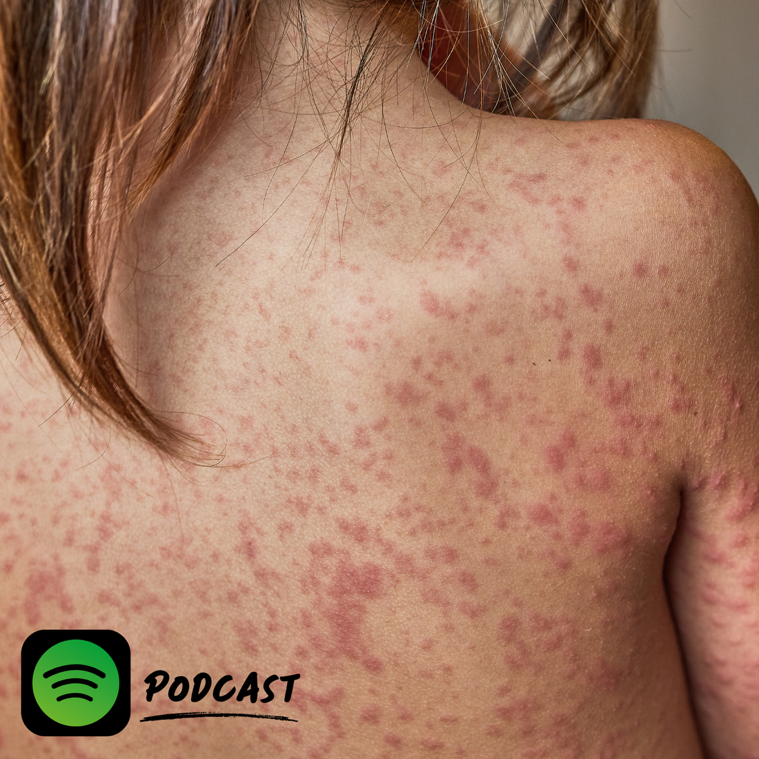 PODCAST | From Start To Finish: The Eight Stages of Psoriasis